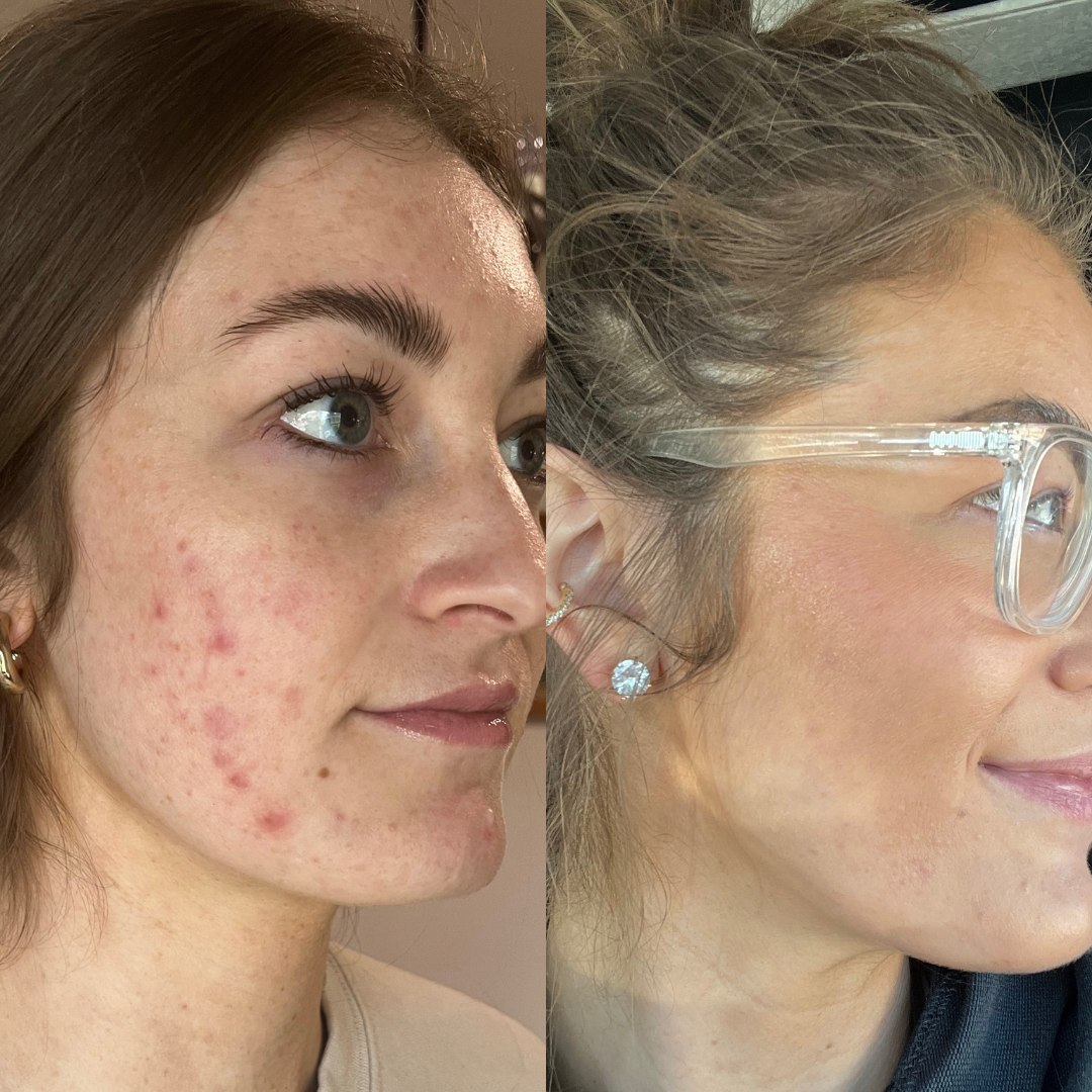 hormonal acne, cystic acne, acne treatment, skincare, virtual esthetician, virtual consultation, clear skin